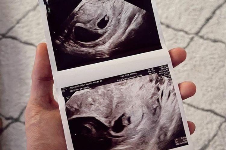 Mengandung Bayi Kembar, Dinda Hauw sudah Diperingatkan Dokter Sebelum Keguguran: Tapi ini