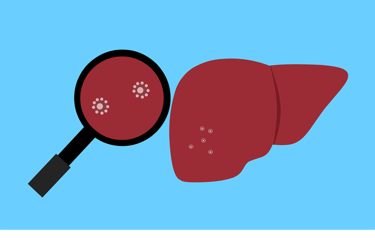 Hepatitis Misterius, Pakar Zubairi Djoerban: antara Adenovirus 41 dan SARS CoV2, atau Kombinasi Keduanya