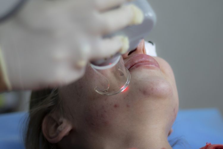 Rutin Cuci Wajah Belum Tentu Bersih Lho, Yuk Kenali 4 Masalah Muka yang Sering Terjadi pada Remaja