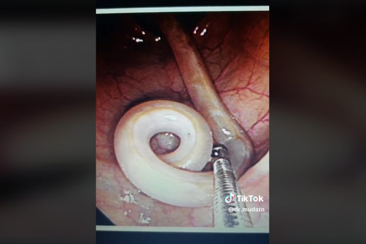 Mengerikan! Cacing Sepanjang 25 cm Hidup di Usus Pria Berusia 45 Tahun