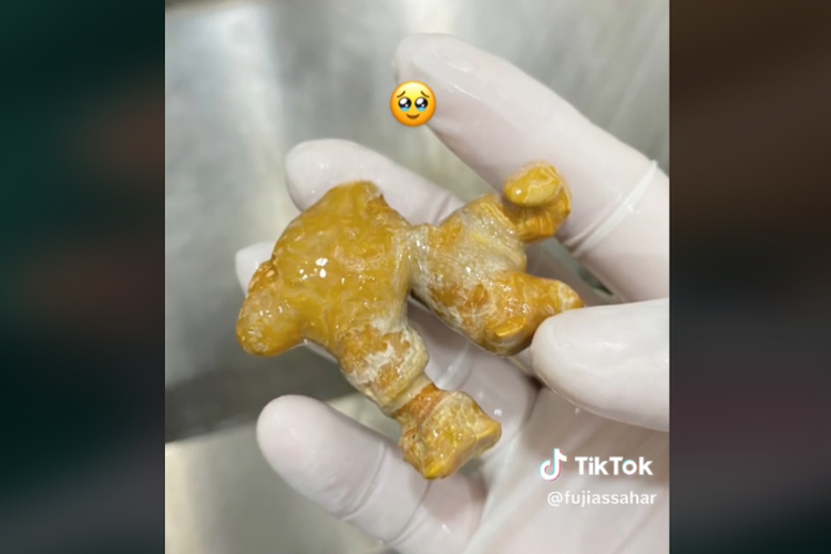 Duh Mengerikan! Batu Ginjal Sebesar Jahe Ditemukan di Tubuh Wanita Ini Gegara Cuman Jarang Minum Air Putih