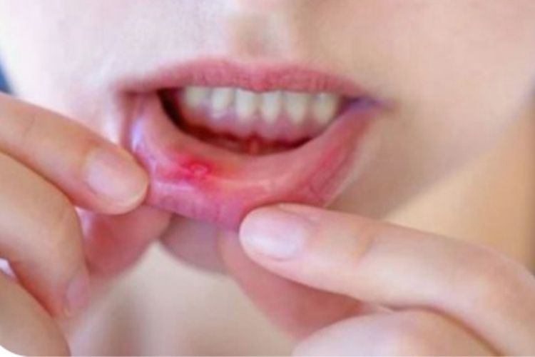 Dijamin Ampuh, Inilah Obat Sariawan Alami yang Wajib Kamu Ketahui!