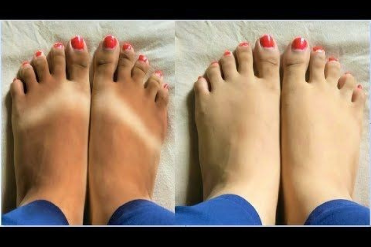 Cuma Modal 10 Ribu, Kulit Kaki Kusam dan Belang Bisa Hilang dalam Sekejap