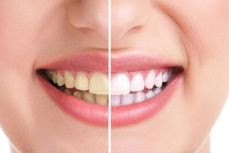 Cara Memutihkan Gigi dengan Bahan Alami Hanya dalam 1 Minggu, Pakai Buah Lemon dan Campuran Ini!