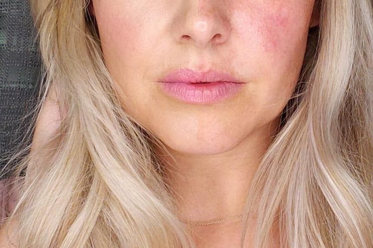 Bolehkah Menggunakan Make up Ketika Sedang Berjerawat? Berikut Ini Cara Pemakaiannya yang Aman untuk Kulit