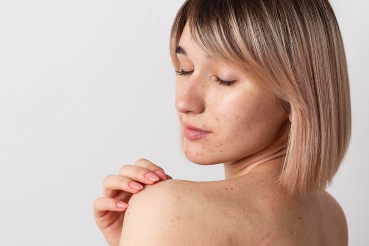 Jerawat Sembuh dalam 1 Malam, Ini Racikan Skincare Alaminya yang Bisa Dibuat di Rumah