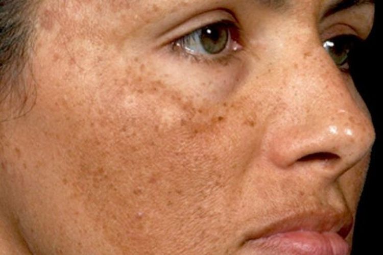 Sudah Mencoba Berbagai Cara Tapi Flek Tidak Kunjung Hilang? Ini Tips Agar Kulit Wajah Jadi Glowing