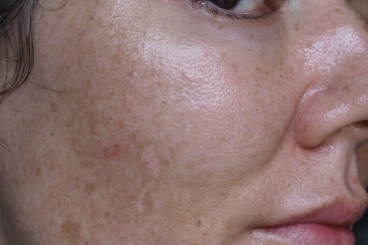 Berikut Cara Ampuh Hilangkan Flek Hitam Melasma di Wajah dengan Aman dan Cepat!
