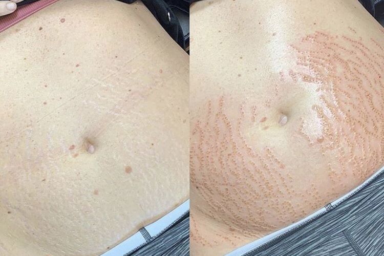 Cara Ampuh Hanya Gunakan Bahan Alami Ini, Dijamin Dapat Hilangkan Stretch Mark