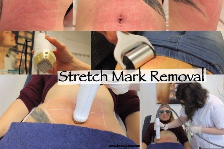 Wow, Ternyata Treatment Mudah Ini Bisa Memudarkan Stretch Mark Tanpa Bekas