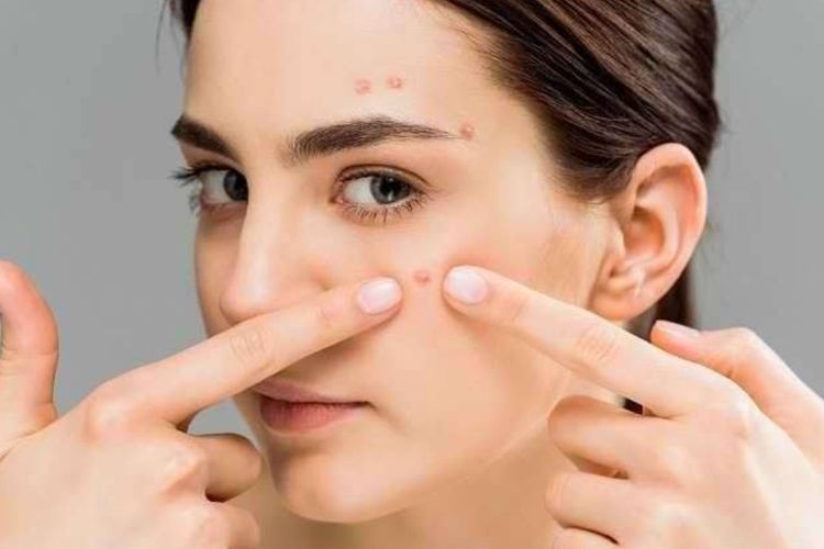 Buat Pejuang Acne, 2 Bahan Alami Ini Ampuh Membasmi Jerawat di Wajah yang Membandel