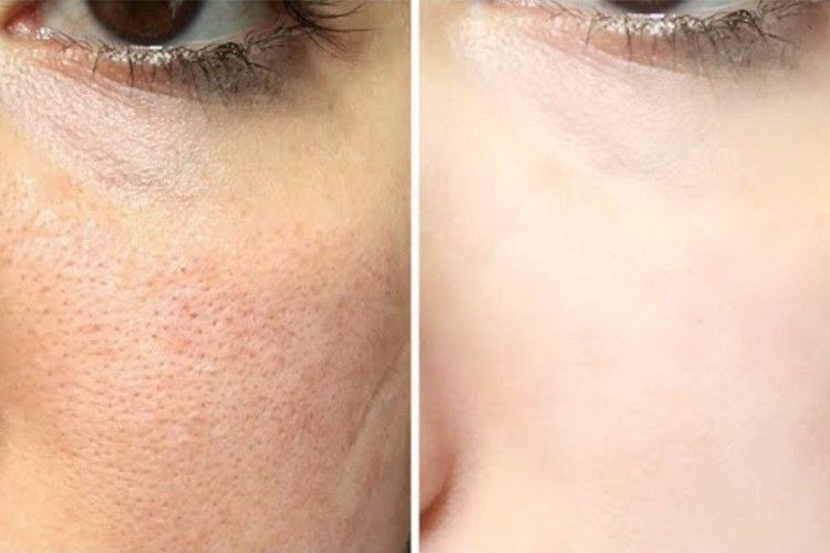 Resep Cream Fondation Murah! Racikan Fair and Lovely dan Viva Bedak Tabur Ini ngak akan bikin Dompet Nangis!