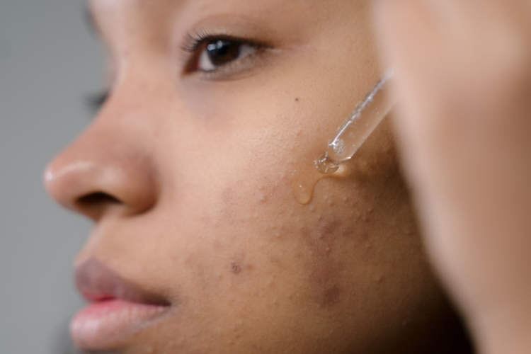 Flek Hitam Mengganggu? Lakukan Cara Mudah Menggunakan Bahan Alami Berikut, Dijamin Ampuh Hilangkan Noda Hitam