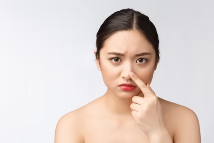 Cara Menghilangkan Komedo Dengan Cepat Dan Mudah, Dijamin Wajah Mulus Seketika