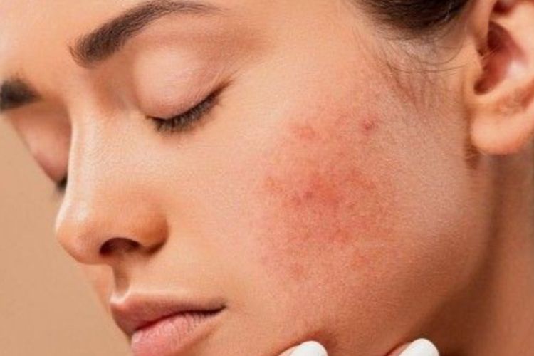 Apa Iya Pemakaian Skincare Setiap Hari Dapat Membuat Kulit Jadi Jenuh dan Ujung-ujungnya Beruntusan?