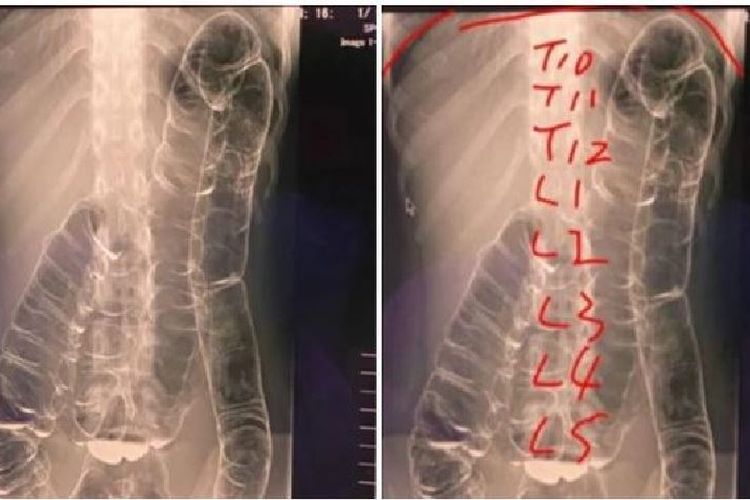 Mencengangkan! Wanita Ini Mengalami Sembelit Usus Sampai ke Jantung