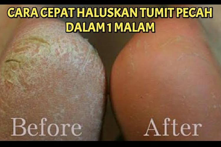 Tumit Pecah-Pecah Auto Mulus dalam Satu Malam, Hanya Pakai Racikan Skincare Garam Dapur