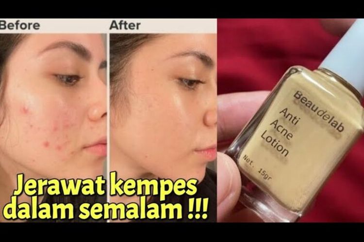 Tampil Percaya Diri Lagi! Ini Cara Cepat Atasi Masalah Jerawat di Wajah yang Sangat Mengganggu