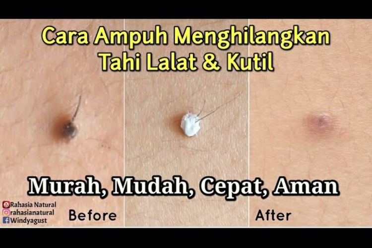 Cepat dan Mudah! Cara Menghilangkan Tahi Lalat dan Kutil Tanpa Rasa Sakit Sedikit pun