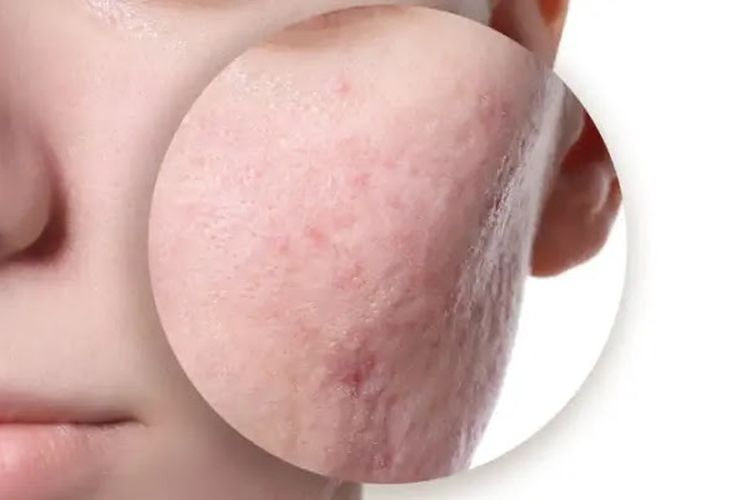 Hal Sepele Yang Sering Diabaikan, Bisa Muncul Jerawat Dan Menyebabkan Bopeng di Wajah, Berikut Cara Mengatasi