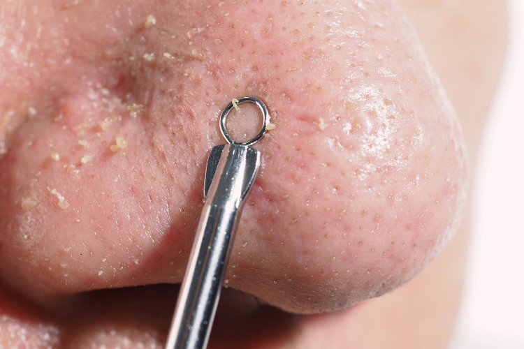 Ternyata Komedo Membandel Bisa Hilang dalam Waktu 2 Hari, Cukup dengan Cara Seperti Ini!