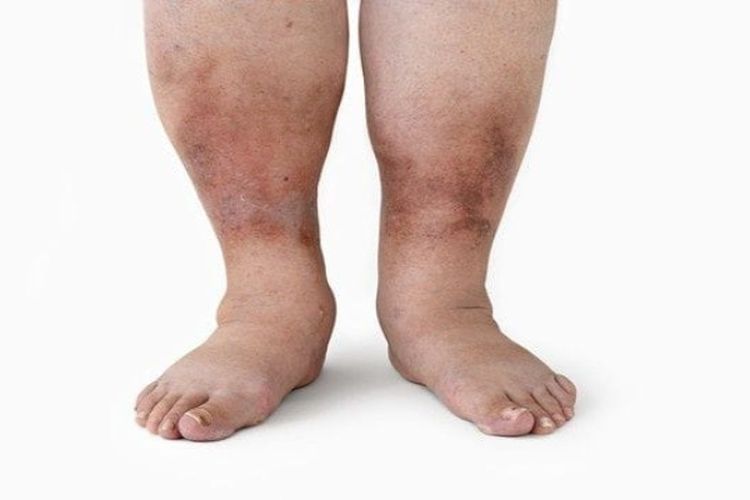 Diabetes Melitus: Waspada Resistensi Insulin, Berikut Jenis-jenisnya dan Cara Pengobatan Yang Benar!