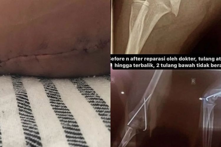 Anak SD di Sukabumi Diduga Jadi Korban Perundungan hingga Alami Patah Tulang, Respon Gurunya…