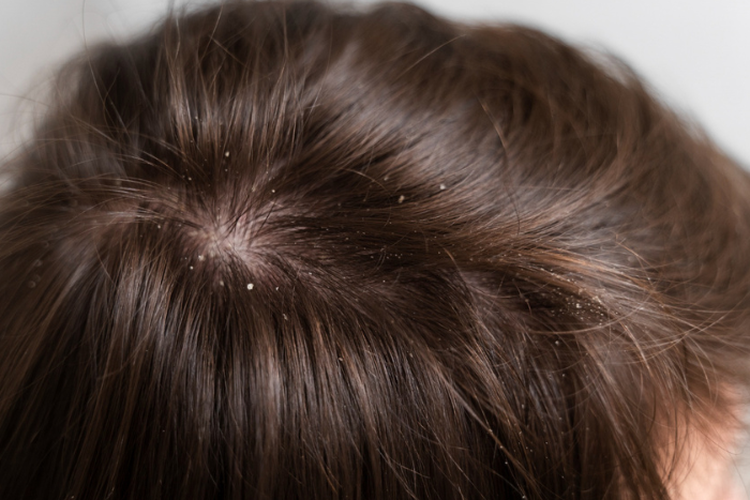 2 Cara Menghilangkan Kutu Rambut Menurut dr Saddam Ismail, Nomor 1 Paling Sederhana