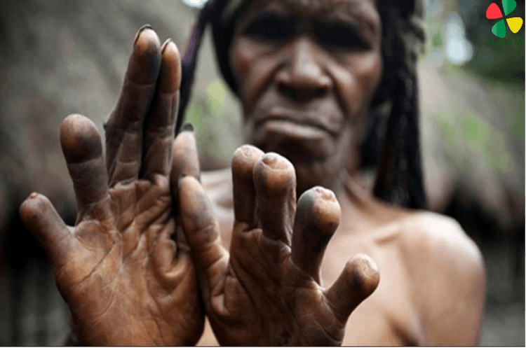 Paling Ekstrim di Indonesia! Begini Tradisi Potong Jari Tiap Kali Ada Kerabat/Keluarga yang Meninggal di Papua