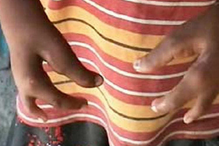 Unik dan Aneh! Dusun Manusia Kepiting di Indonesia dengan Warga Berjari Tiga, Kutukan?